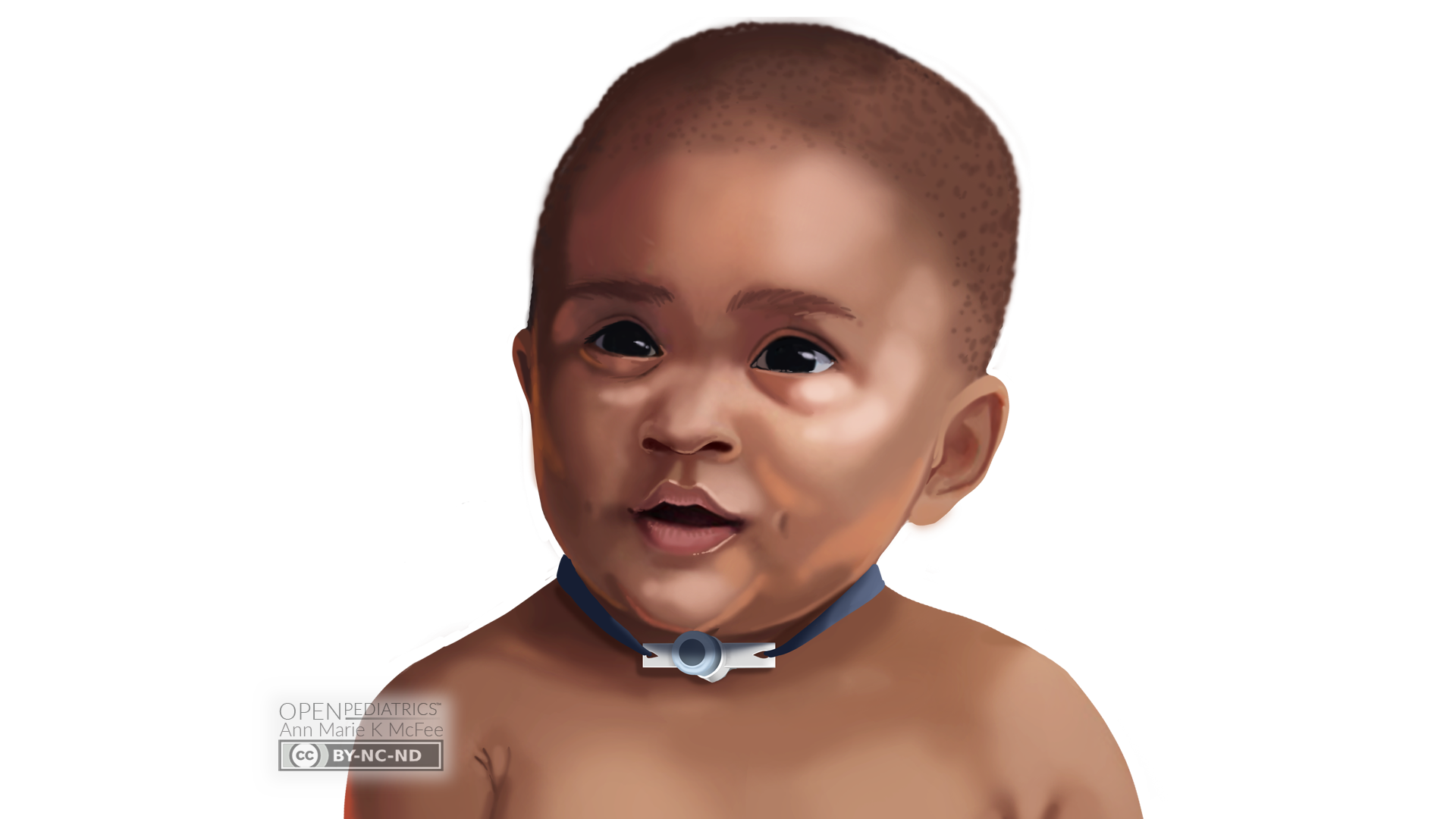 Toddler with tracheostomy